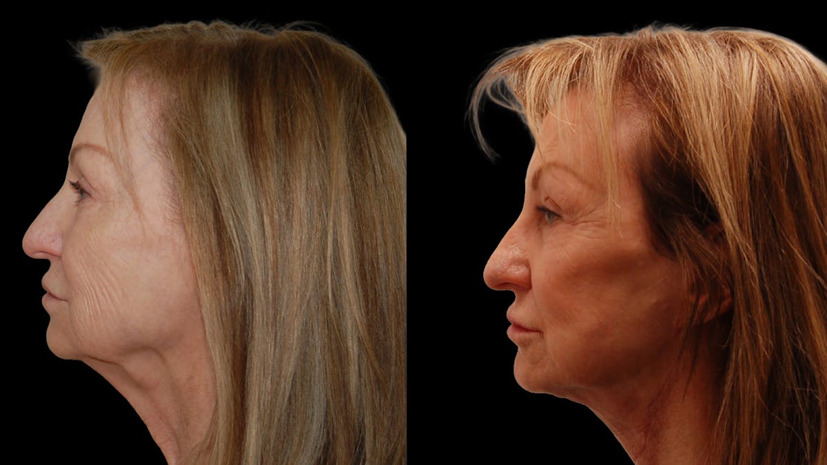Neck Lift Before & After Gallery - Patient 839976 - Image 5