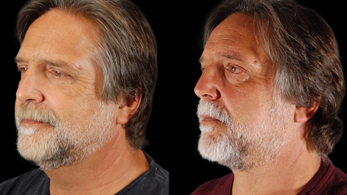 Neck Lift Before & After Gallery - Patient 795057 - Image 1