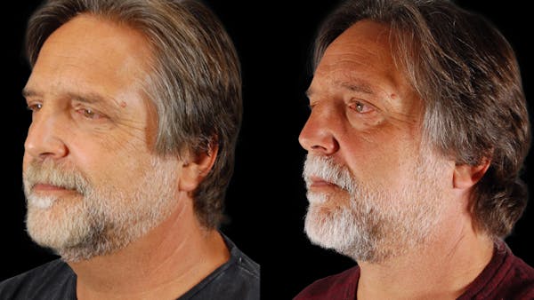 Neck Lift Before & After Gallery - Patient 795057 - Image 1
