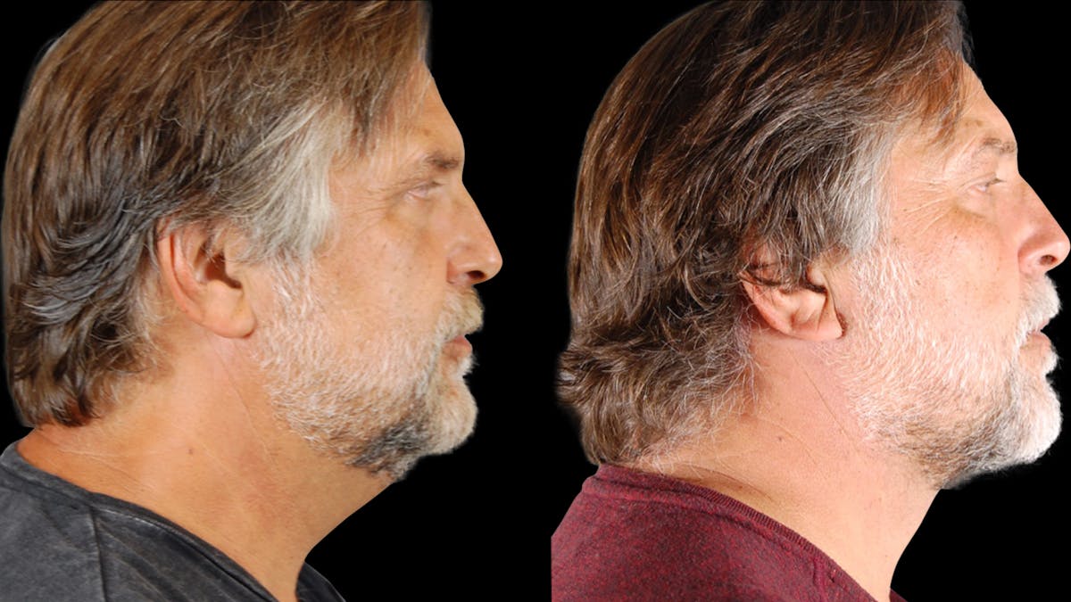 Neck Lift Before & After Gallery - Patient 795057 - Image 2