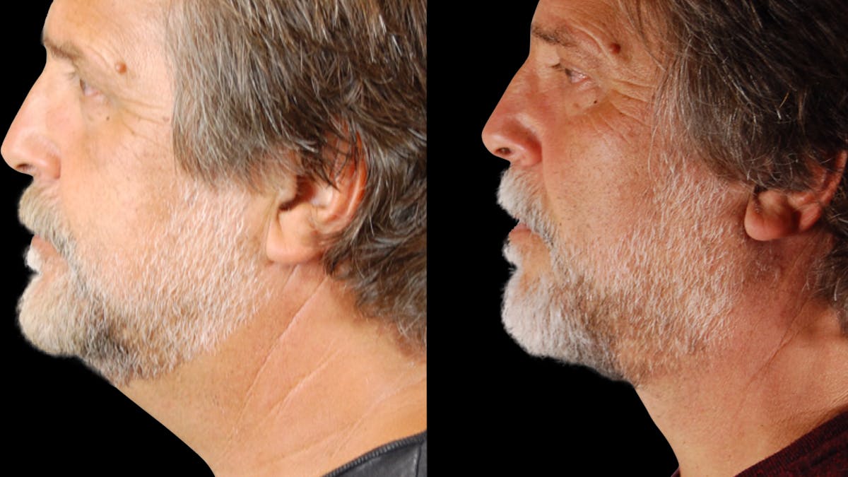 Neck Lift Before & After Gallery - Patient 795057 - Image 3