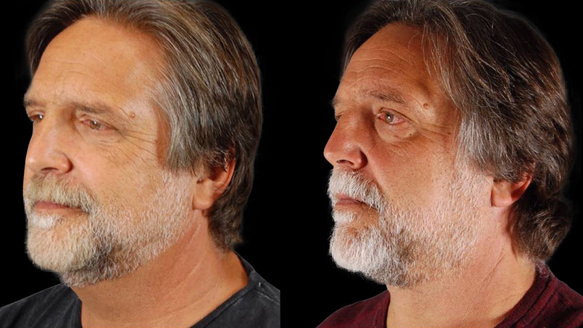 Neck Lift Before & After Gallery - Patient 795057 - Image 4