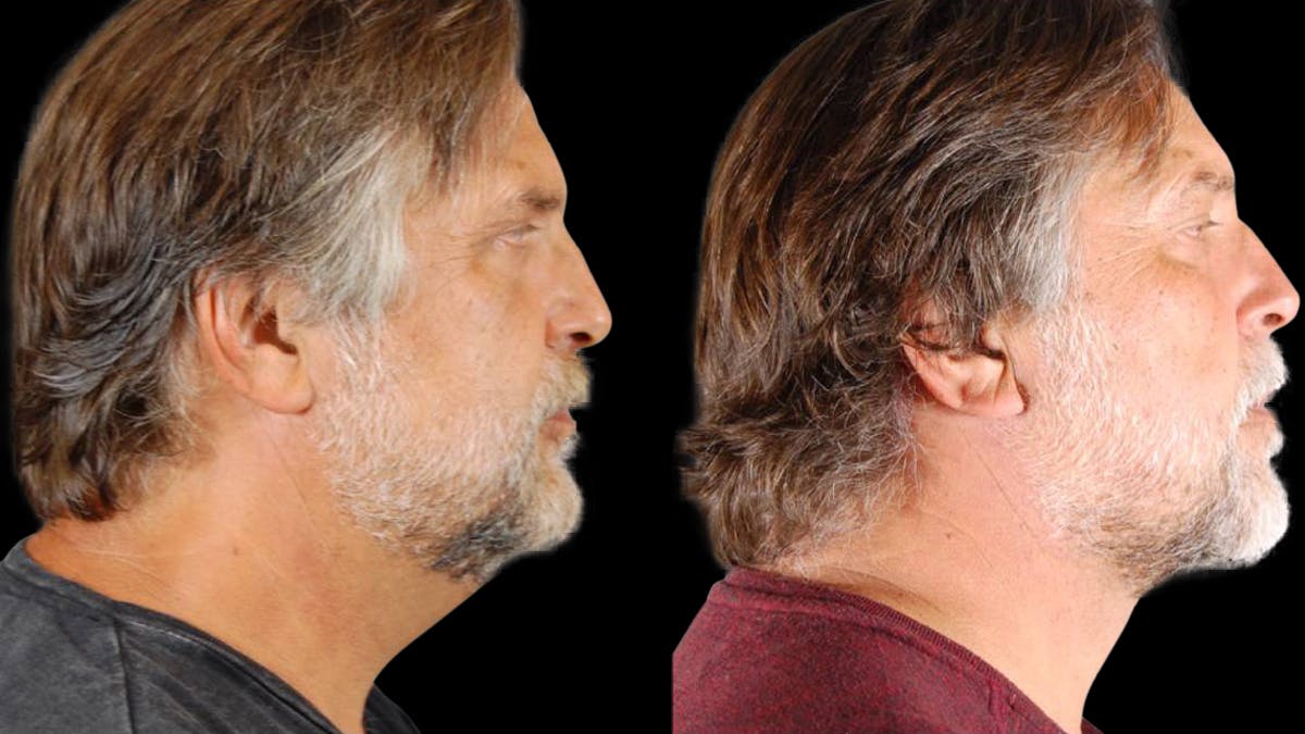 Neck Lift Before & After Gallery - Patient 795057 - Image 5