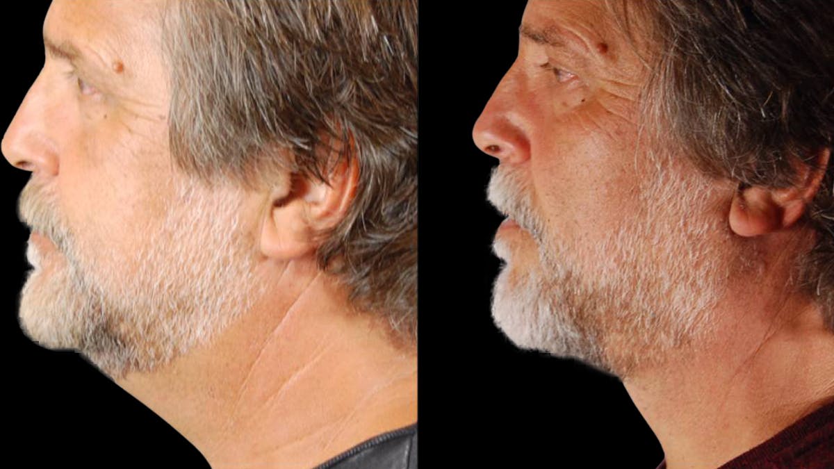 Neck Lift Before & After Gallery - Patient 795057 - Image 6
