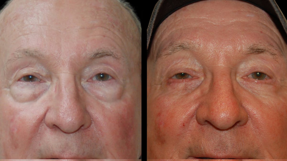 Neck Lift Before & After Gallery - Patient 367710 - Image 5