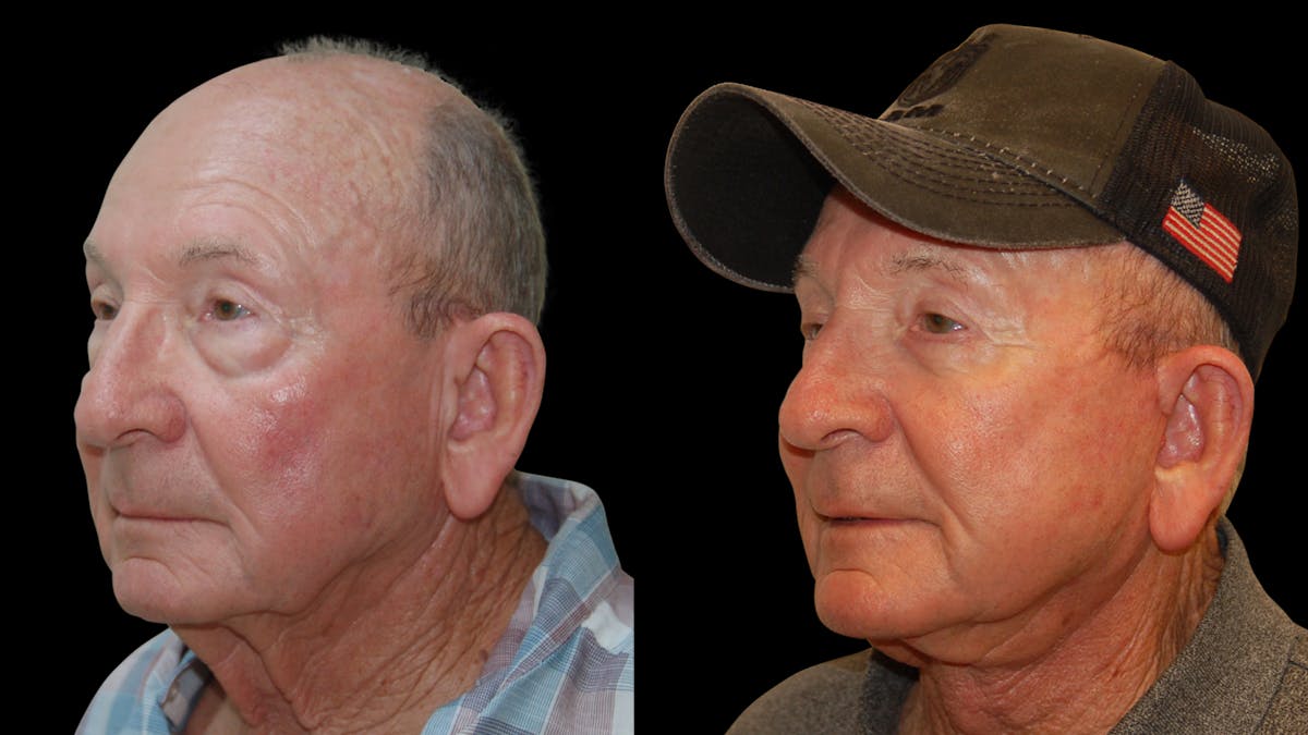 Neck Lift Before & After Gallery - Patient 367710 - Image 1