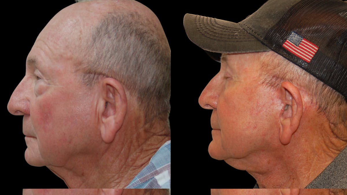 Neck Lift Before & After Gallery - Patient 367710 - Image 4