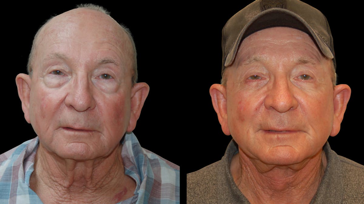 Neck Lift Before & After Gallery - Patient 367710 - Image 2