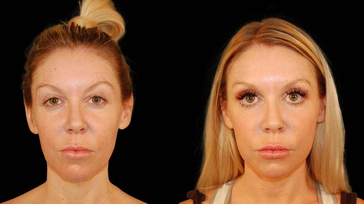 Neck Lift Before & After Gallery - Patient 485990 - Image 2
