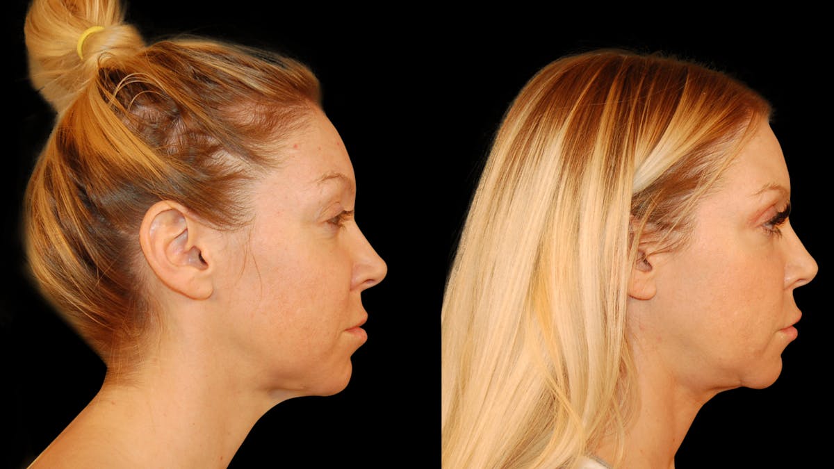 Neck Lift Before & After Gallery - Patient 485990 - Image 3