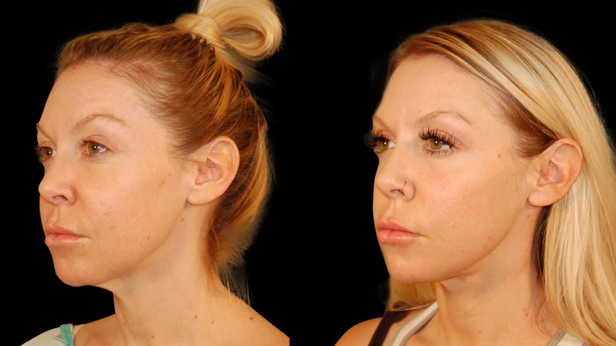 Neck Lift Before & After Gallery - Patient 485990 - Image 1