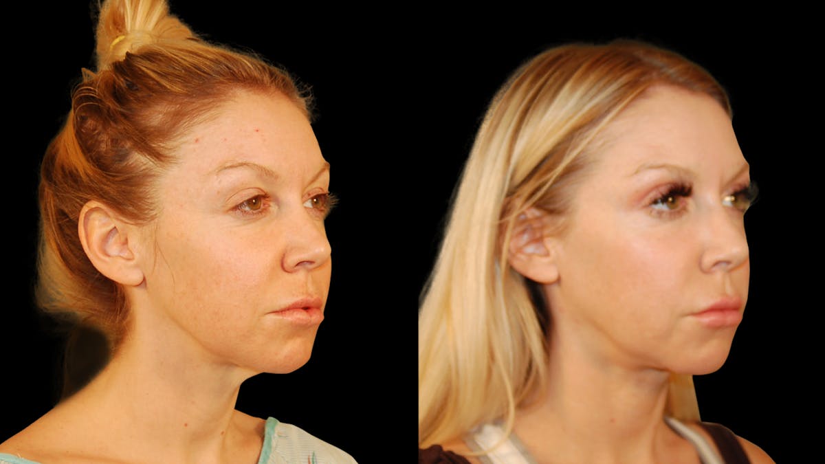Neck Lift Before & After Gallery - Patient 485990 - Image 4