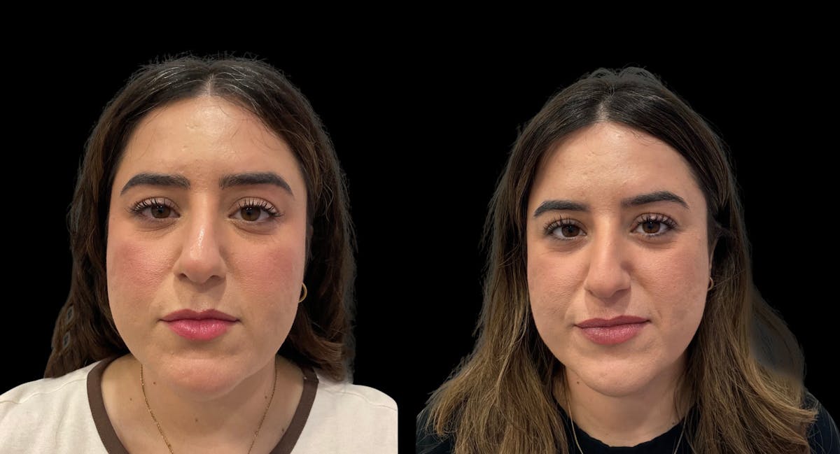 Submental Liposuction Before & After Gallery - Patient 204833 - Image 3