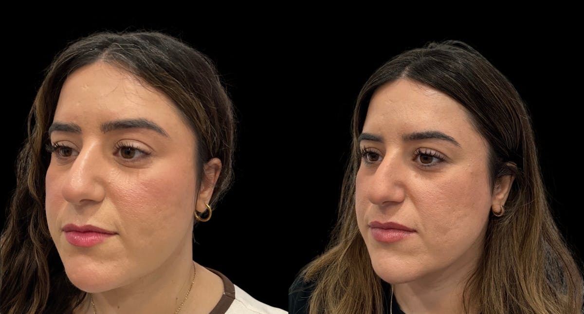 Submental Liposuction Before & After Gallery - Patient 204833 - Image 2