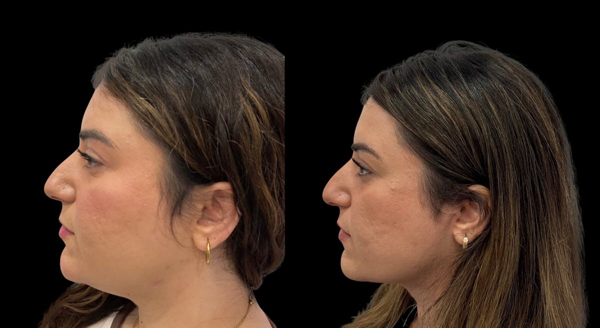Submental Liposuction Before & After Gallery - Patient 204833 - Image 1