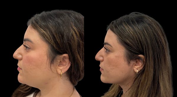 Submental Liposuction Before & After Gallery - Patient 204833 - Image 1