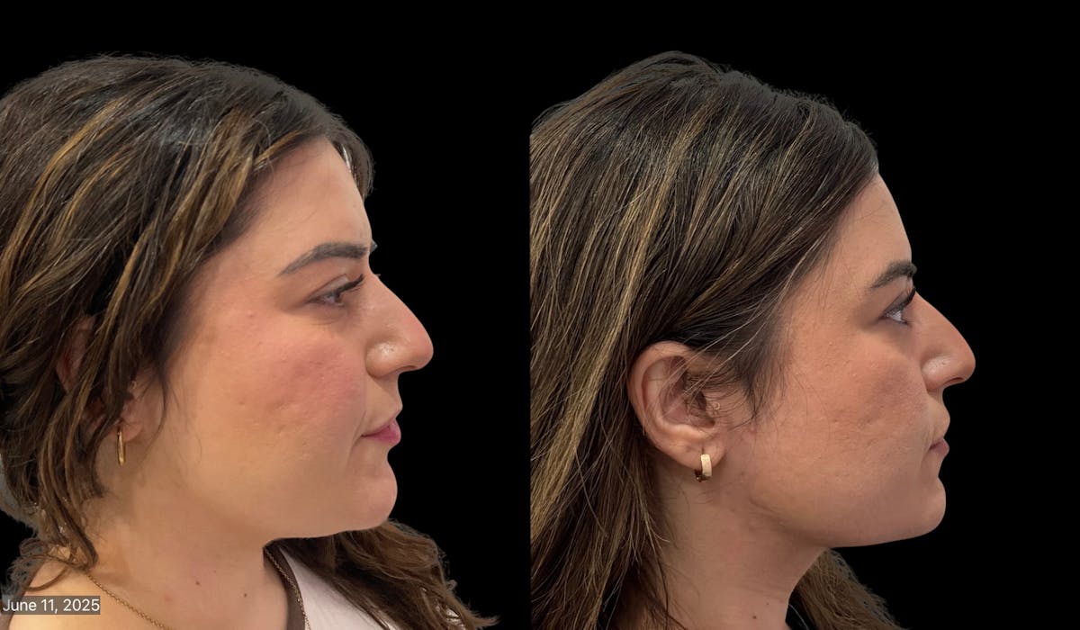 Submental Liposuction Before & After Gallery - Patient 204833 - Image 4
