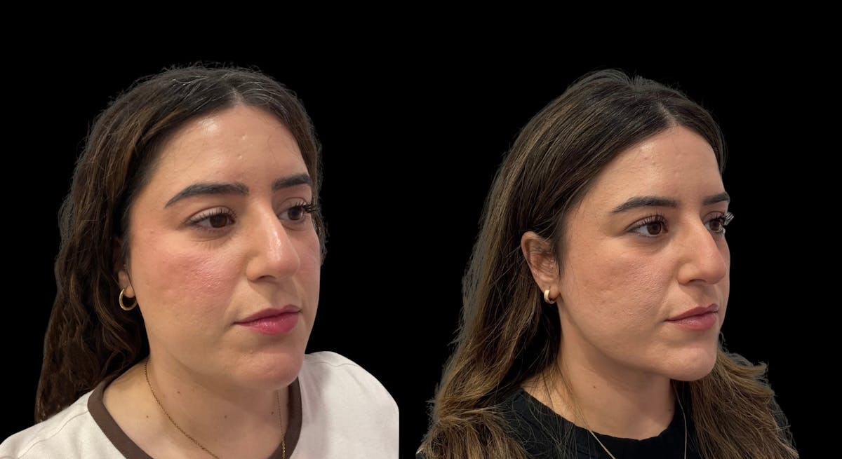 Submental Liposuction Before & After Gallery - Patient 204833 - Image 5