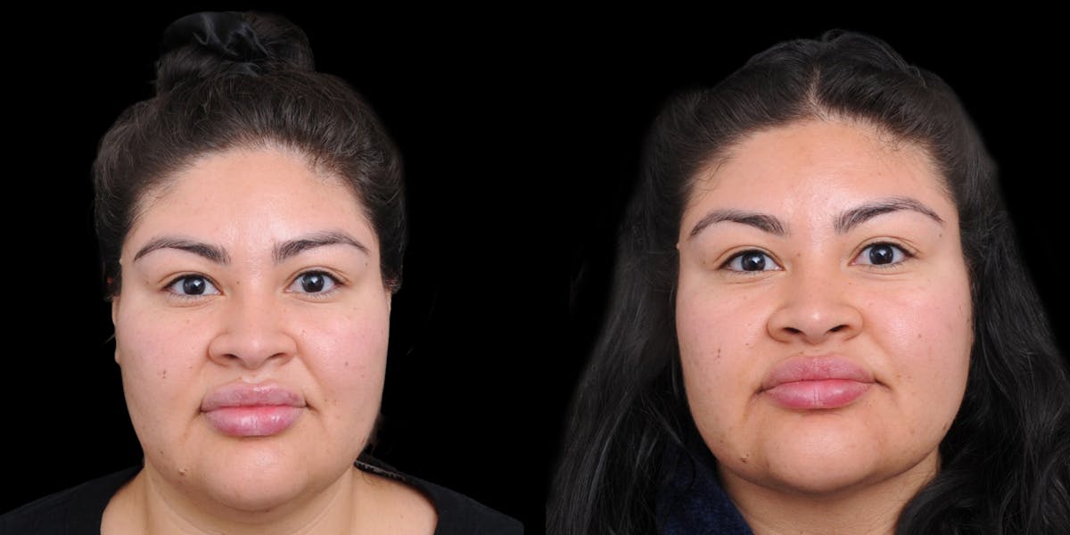 Submental Liposuction Before & After Gallery - Patient 254765 - Image 3