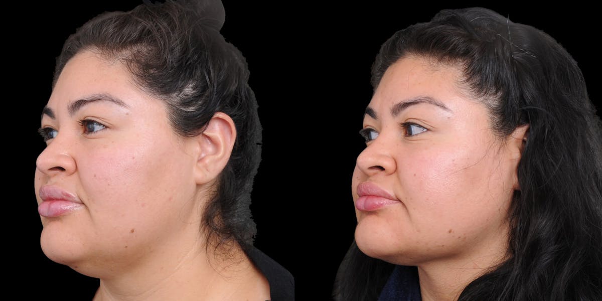 Submental Liposuction Before & After Gallery - Patient 254765 - Image 2