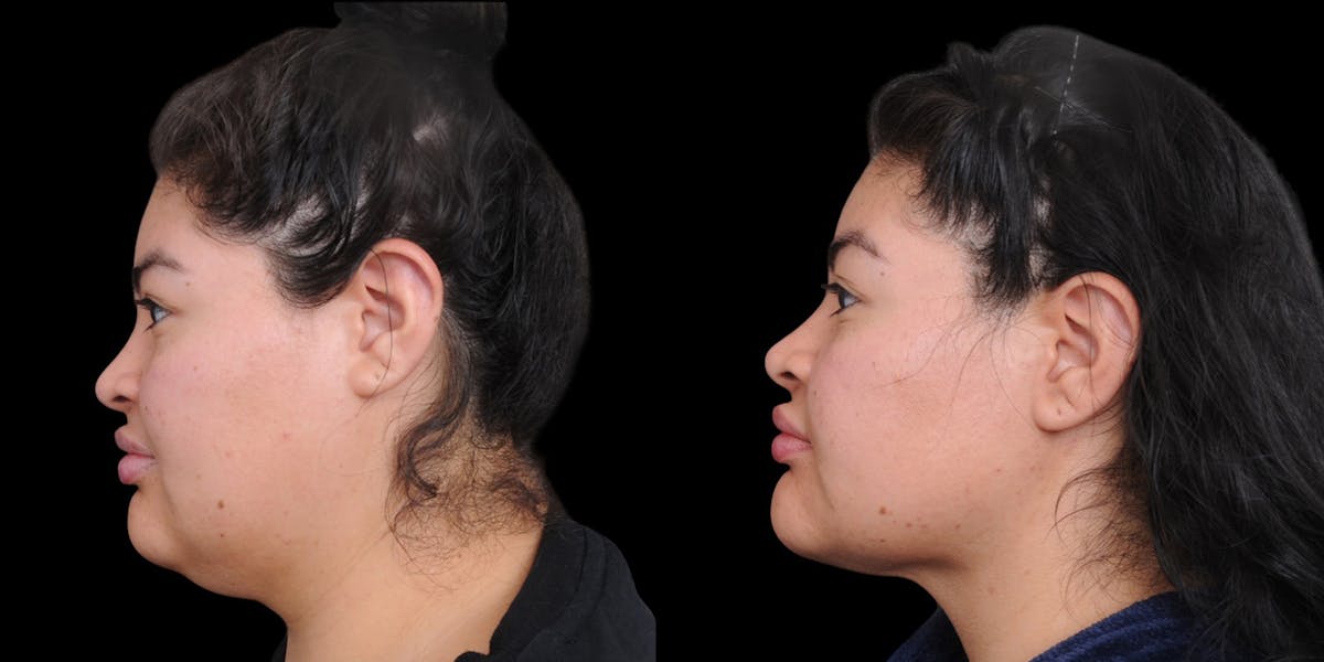 Submental Liposuction Before & After Gallery - Patient 254765 - Image 1