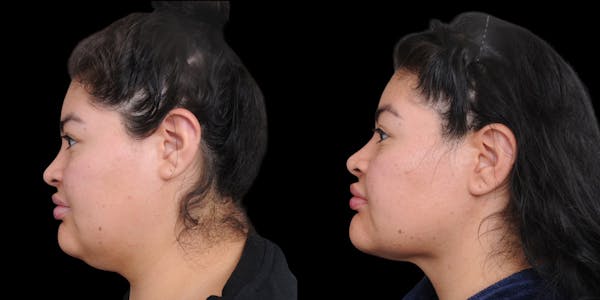 Submental Liposuction Before & After Gallery - Patient 254765 - Image 1