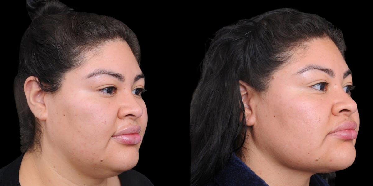 Submental Liposuction Before & After Gallery - Patient 254765 - Image 4