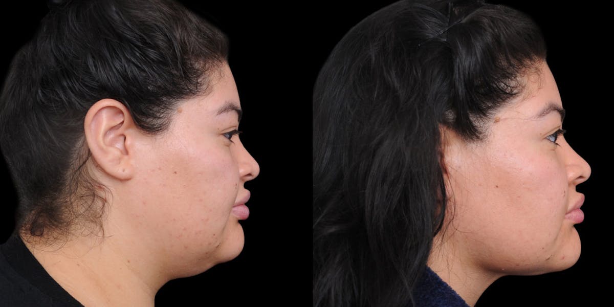 Submental Liposuction Before & After Gallery - Patient 254765 - Image 5