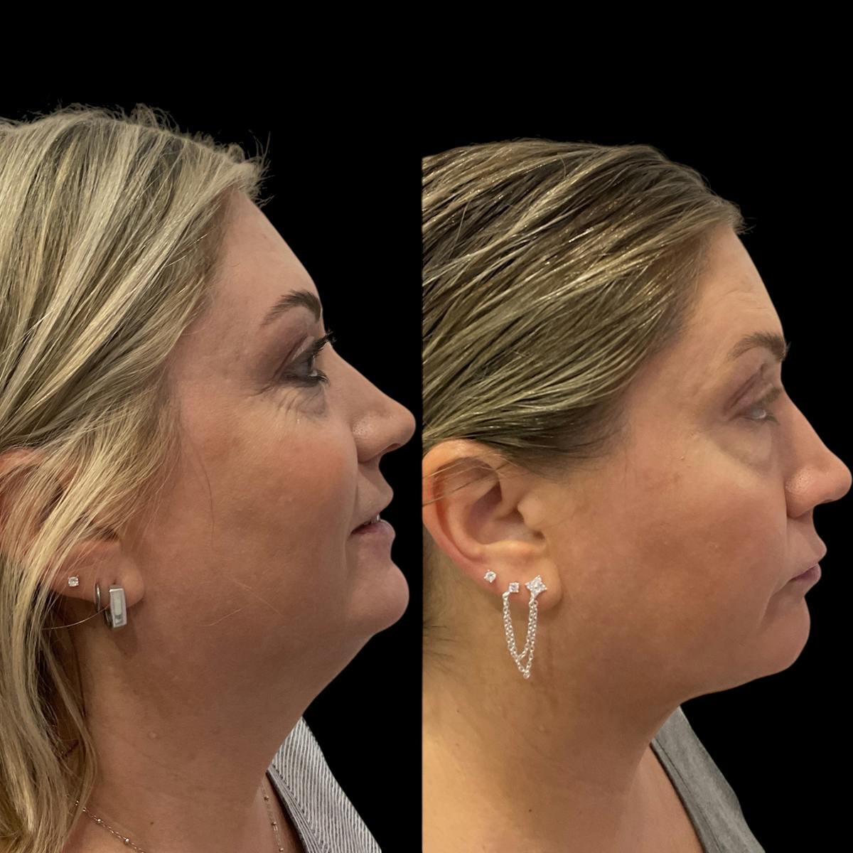 Submental Liposuction Before & After Gallery - Patient 153709 - Image 3