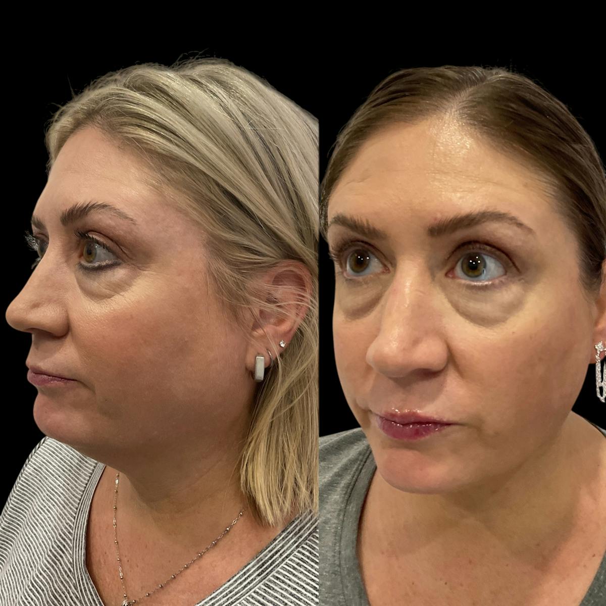Submental Liposuction Before & After Gallery - Patient 153709 - Image 2