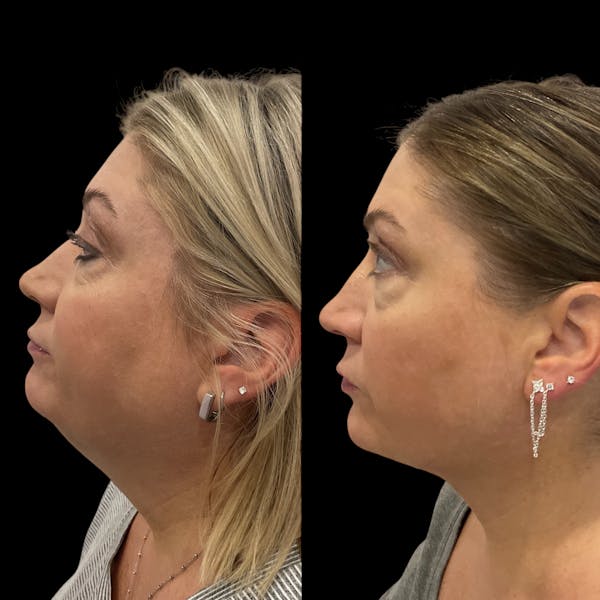 Submental Liposuction Before & After Gallery - Patient 153709 - Image 1