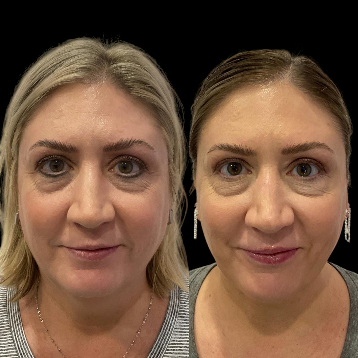 Submental Liposuction Before & After Gallery - Patient 153709 - Image 4