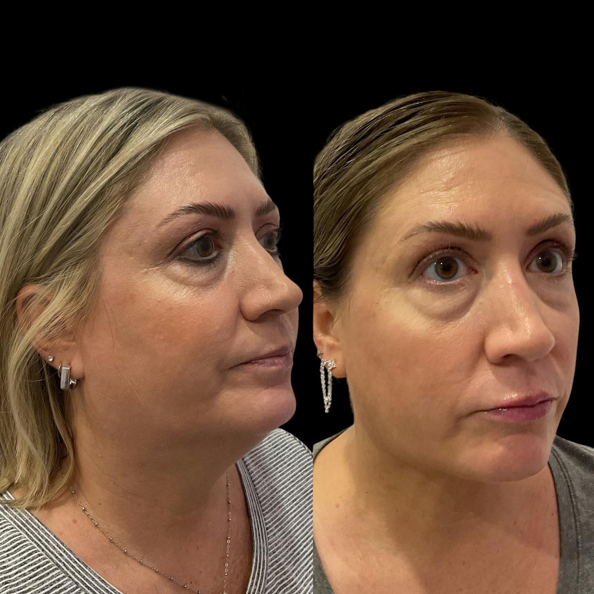 Submental Liposuction Before & After Gallery - Patient 153709 - Image 5