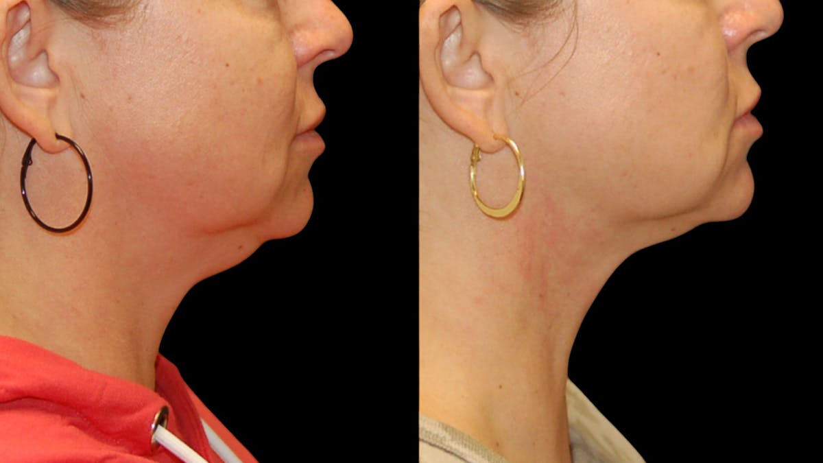 Submental Liposuction Before & After Gallery - Patient 153709 - Image 6