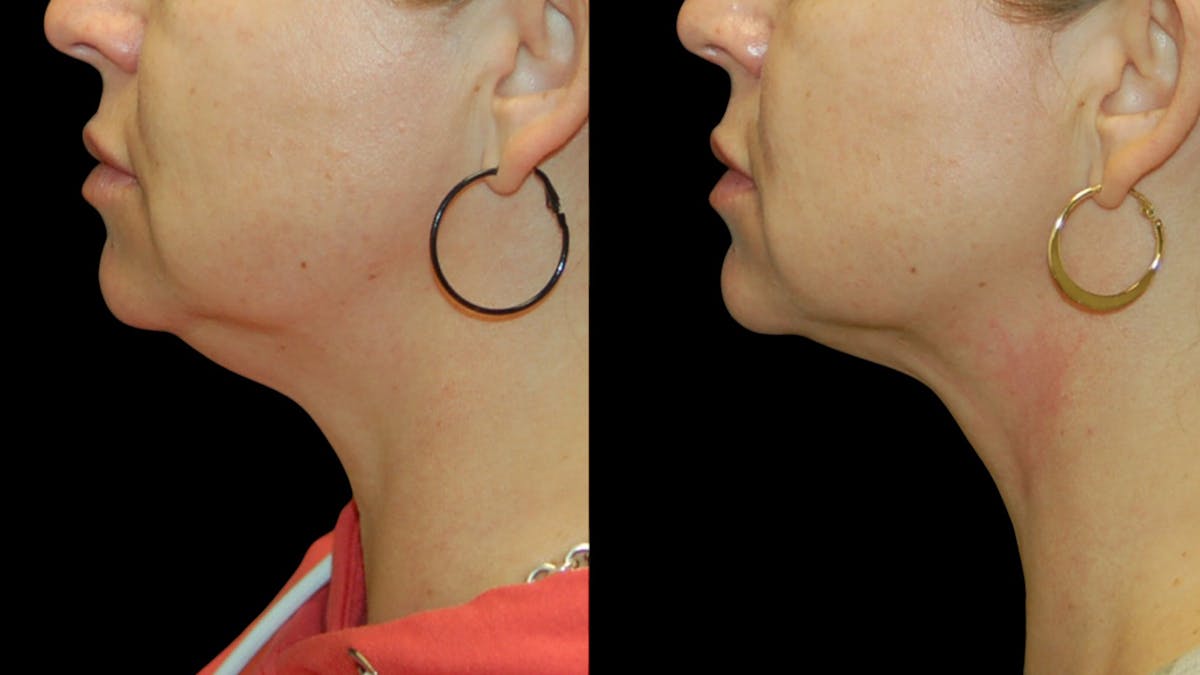 Submental Liposuction Before & After Gallery - Patient 153709 - Image 7