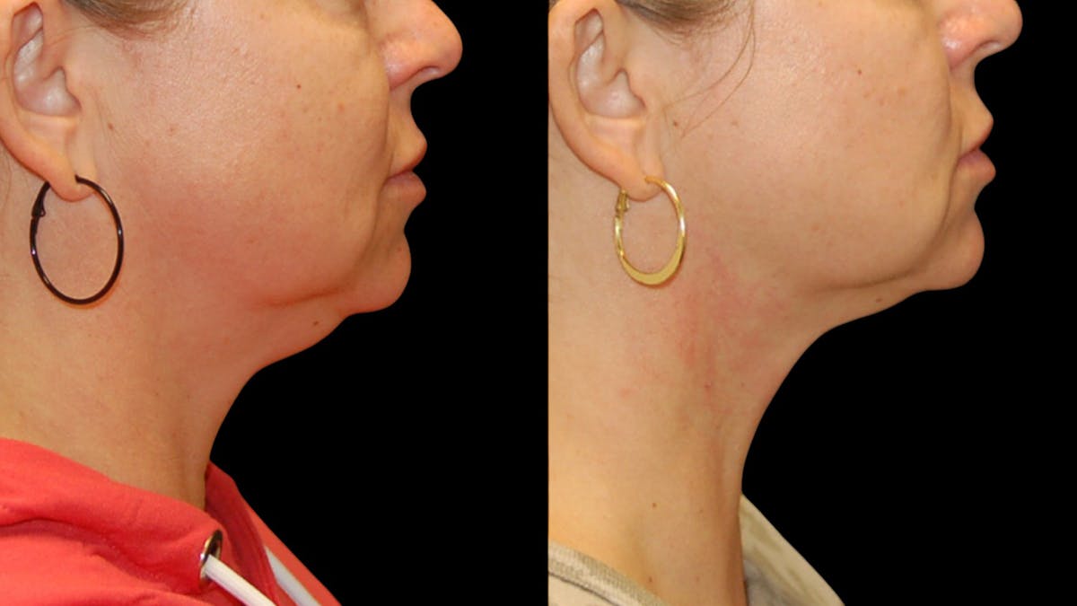 Submental Liposuction Before & After Gallery - Patient 403911 - Image 2