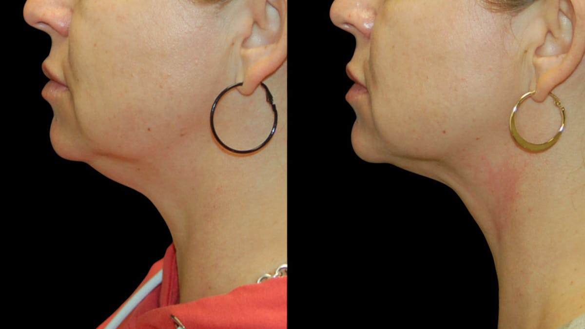 Submental Liposuction Before & After Gallery - Patient 403911 - Image 1