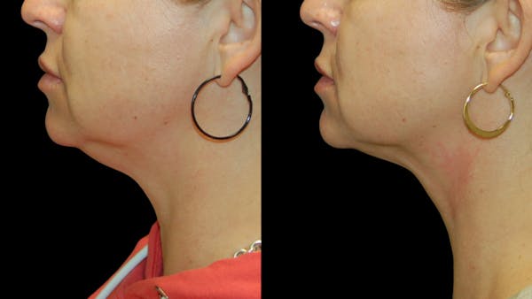 Submental Liposuction Before & After Gallery - Patient 403911 - Image 1