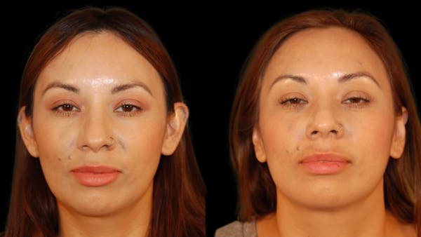Otoplasty Before & After Gallery - Patient 340503 - Image 1