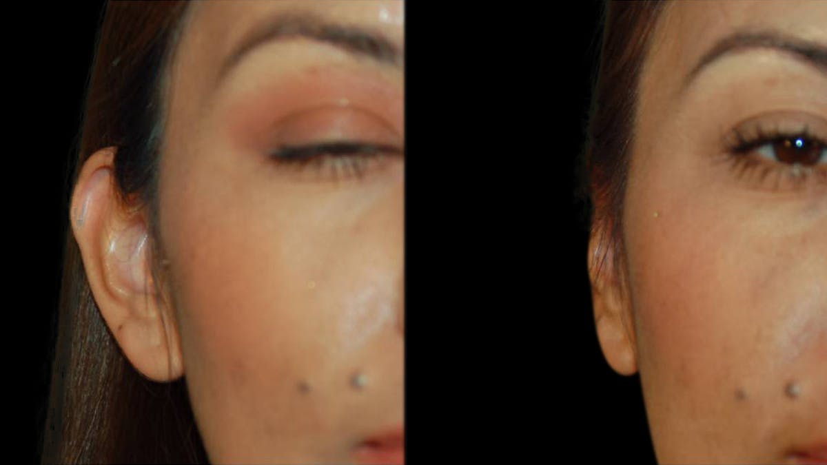 Otoplasty Before & After Gallery - Patient 340503 - Image 2