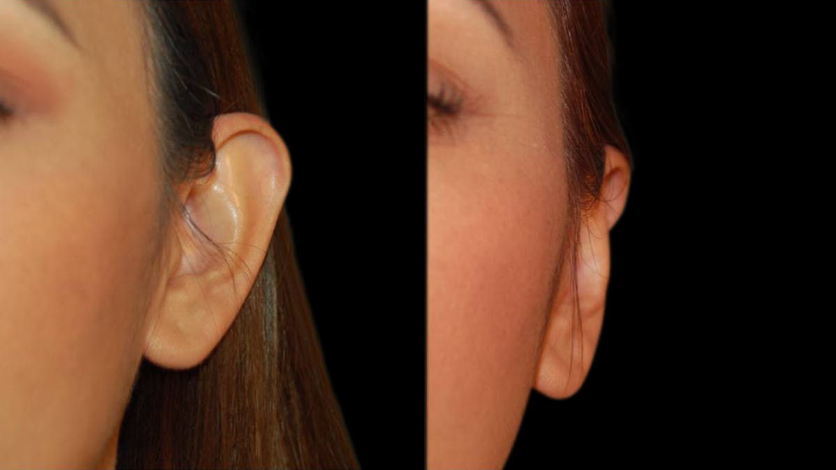 Otoplasty Before & After Gallery - Patient 340503 - Image 3
