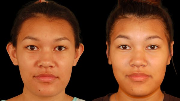 Otoplasty Before & After Gallery - Patient 421587 - Image 1