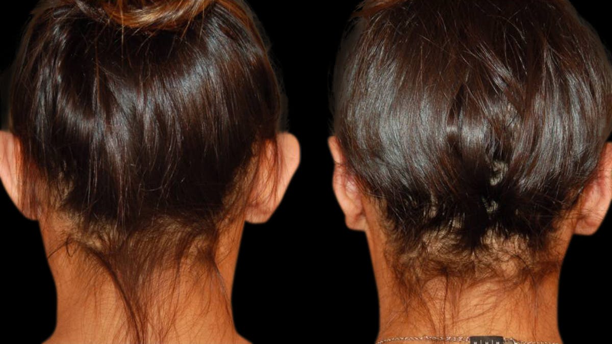 Otoplasty Before & After Gallery - Patient 421587 - Image 2