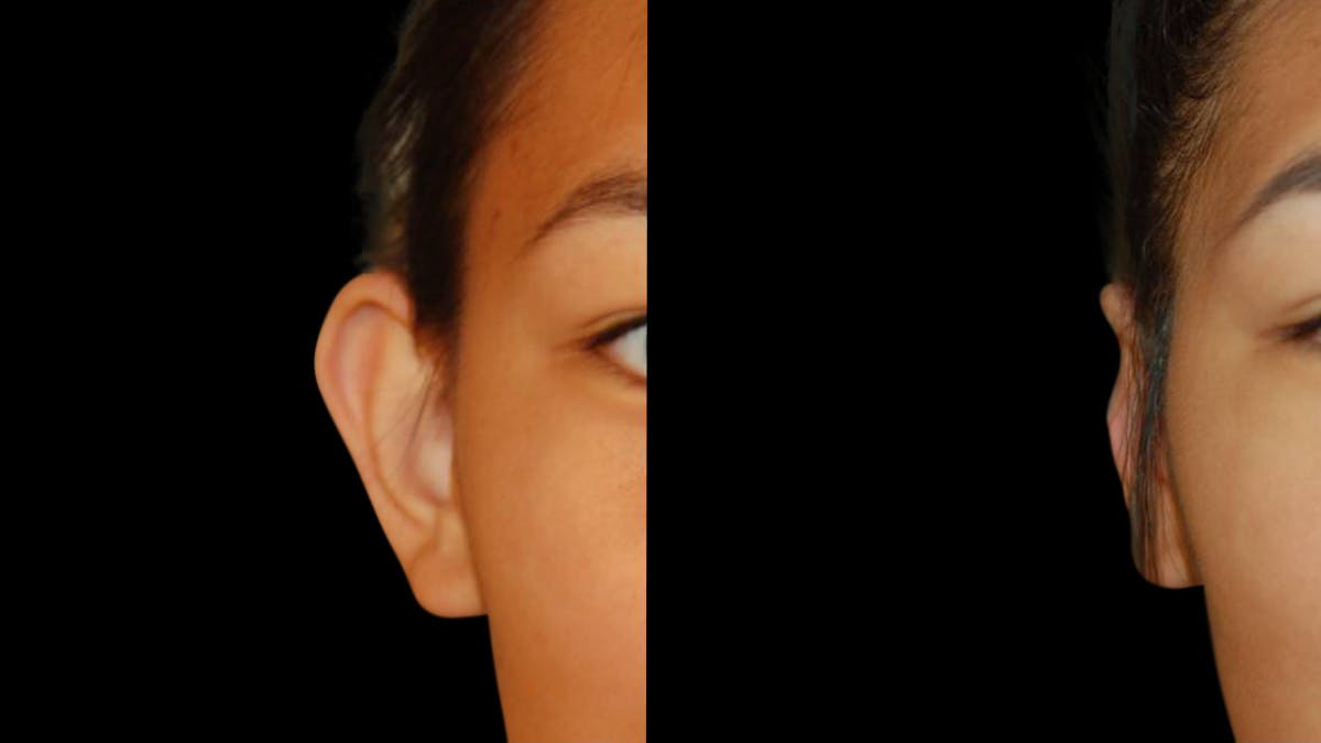 Otoplasty Before & After Gallery - Patient 421587 - Image 3