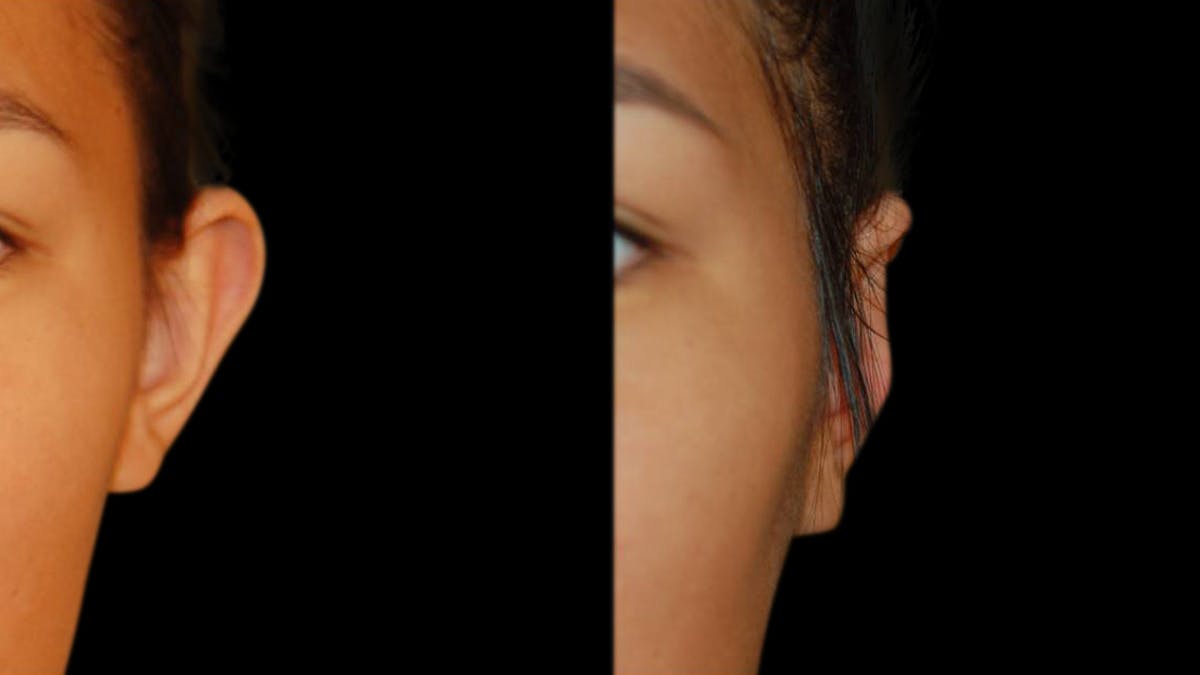 Otoplasty Before & After Gallery - Patient 421587 - Image 4