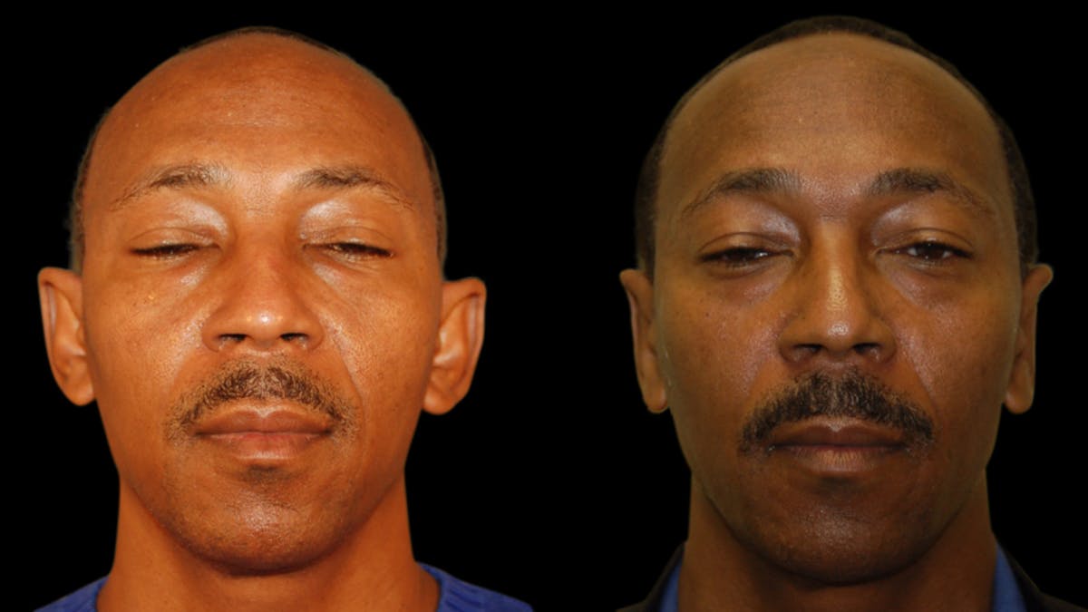Otoplasty Before & After Gallery - Patient 269643 - Image 1