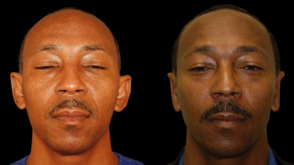 Otoplasty Before & After Gallery - Patient 269643 - Image 1