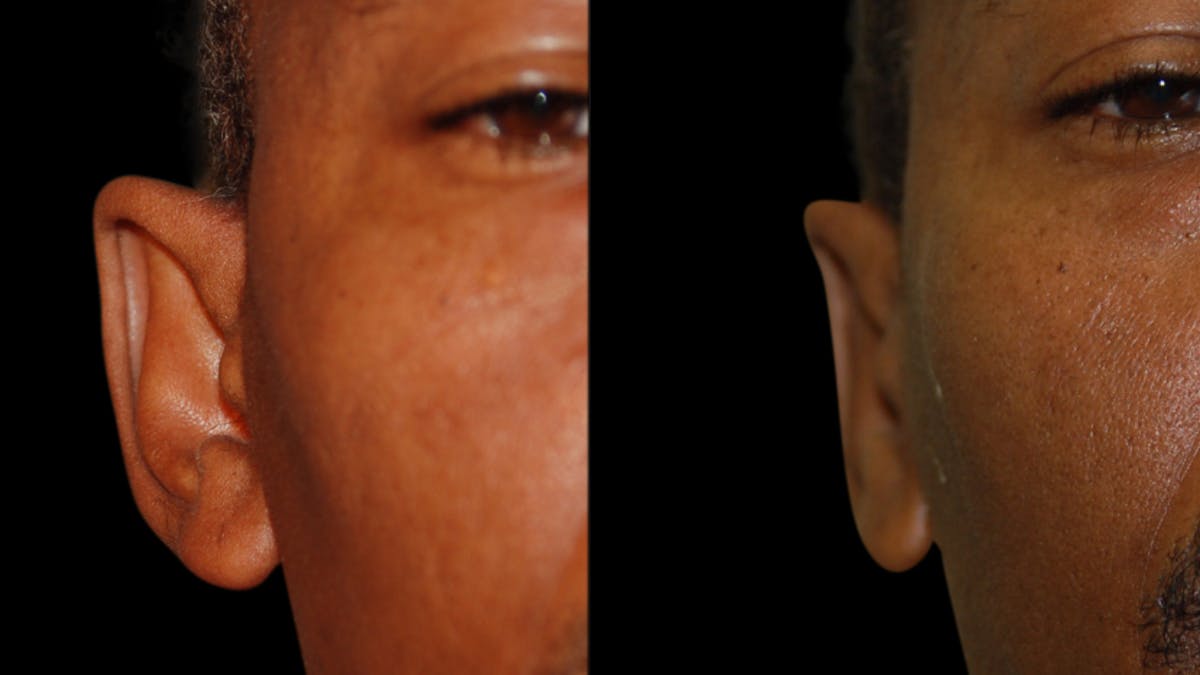 Otoplasty Before & After Gallery - Patient 269643 - Image 2
