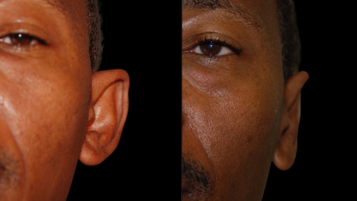 Otoplasty Before & After Gallery - Patient 269643 - Image 3