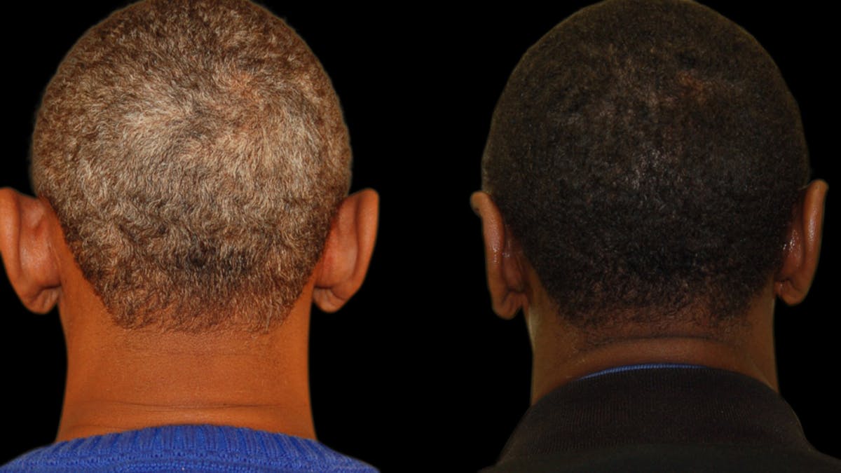 Otoplasty Before & After Gallery - Patient 269643 - Image 4